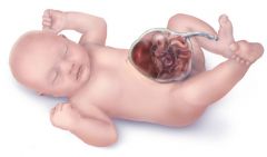 setting: Newborn.  May be associated with trisomies 18, 13, 21.

Presentation: 
 - Abdominal defect WITH a sac
 - Through the umbilicus
 - Absent umbilical ring
 - May have polyhydramnios in utero