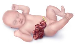 Setting: Newborn

Presentation: 
 - Abdominal defect lateral to midline
 - NO sac
 - Associated with intestinal atresia