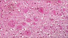 What is the abnormality in this brain tissue?