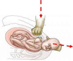 1. Suprapubic pressure whilst in McRobert’s position
     - Hands in CPR position behind symphysis pubis, at 45 degree angle along baby’s back (trying to rotate baby forward)
     - Apply 30 secs firm downward pressure, then 30 secs rocking ...