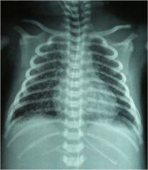 Setting: Term infant with hyposia or fetal distress in utero

Presentation:
 - Severe respiratory distress
 - Hypoxemia
 - CXR with patchy infiltrate, air trapping, flattening of the diaphragm