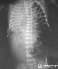 Dyspnea at birth
Loops of bowel in left chest
Scaphoid abdomen
Respiratory distress
Pulmonary hypoplasia