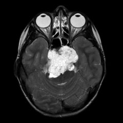 Unusual locally aggressive neoplasm of the clivus; impacts the temporal bones by lateral extension of the tumor into the CPA or lower cranial nerves
Mets are rare