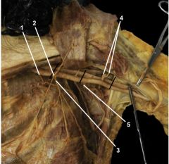 Identify:
Superior thoracic artery
Thoracoacromial artery
Lateral thoracic artery
Posterior & anterior circumflex humeral arteries
Subscapular artery