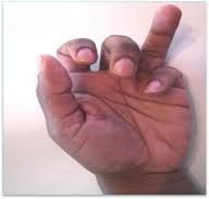what is the Jersey finger?
