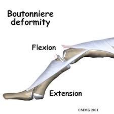 what is a Boutonniere deformity?