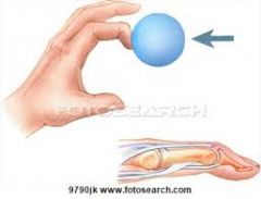 what is mallet finger?