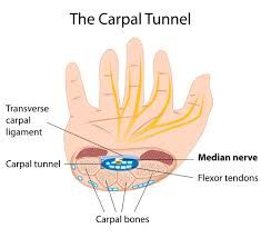 what is carpal tunnel syndrome?