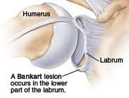 what is a Bankart lesion and what would most likely cause it?