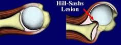 what is a Hills Sachs lesion?