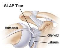 what is a SLAP lesion?