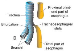Esophageal Atresia: 90% the upper part of the esophagus ends in a blind pouch w/ lower segment forming a tracheoesophageal fistula

Tracheoesophageal fistula: connection btwn the trachea & esophagus-->pneumonia & polyhydramnios