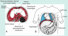 cause: 
-oligohydramnios, prevents expansion in thoracic cavity
-congenital diaphragmatic hernia, most common cause
leads to: underdeveloped lungs