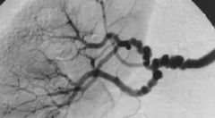 "String of beads" appearance on Renal Artery