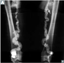 "Pipestem" appearance on X-ray