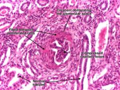 ACUTE RENAL FAILURE
Glomerular lesions