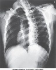 Examine the image below. Which ribs are best demonstrated?