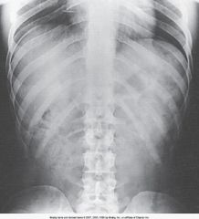 What breathing instructions are given to the patient prior to making the exposure for this image?
