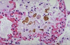 Presence of hemosiderin-laden macrophages in lungs
What heart condition you might suspect?