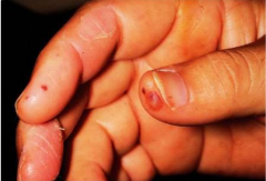 Tender raised lesions on finger or toe pads