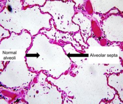 L: Normal Alveoli
R: Alveolar Septa