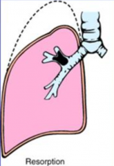 Complete Airway Obstruction:
- Mucus/mucopurulent plug following surgery
- Aspiration of foreign materials
- Bronchial asthma, bronchitis, bronchiectasis
- Bronchial neoplasms (caveat - total obstruction)
