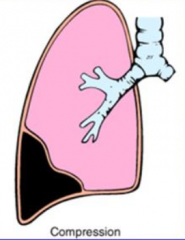 Air or fluid accumulation in pleural cavity, increases pressure and collapses underlying lung