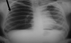 Compression Atelectasis d/t Pneumothorax:
- Note that R lung has a darker / lucent appearance because of presence of air occupying almost entire pleural space
- R lung is next to mediastinum
- Deviation of trachea to contralateral side