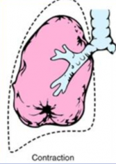 - Fibrotic changes in lung parenchyma or pleura
- Prevents full expansion
- Not reversible