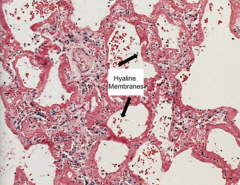 Hyaline Membrane in Acute Respiratory Distress Syndrome