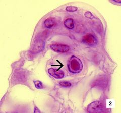 Intranuclear eosinophilic droplet-like bodies