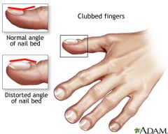 elevation of the proximal aspect of the nail & sofetning of the nail bed