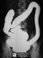 “Lead pipe” appearance of colon on barium enema x-ray