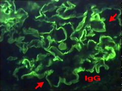 Linear appearance of IgG deposition on glomerular basement membrane