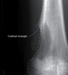 Codman triangle on x-ray (osteosarcoma, Ewing sarcoma, pyogenic osteomyelitis)