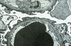 Podocyte fusion or “effacement” on electron microscopy