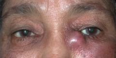 inflammation of the lacrimal sac