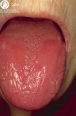 inflammation of the tongue