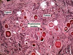 Meningiomas, papillary thyroid carcinoma, mesothelioma, papillary serous carcinoma of the endometrium and ovary