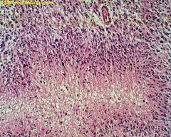 Pseudopalisading tumor cells on brain biopsy