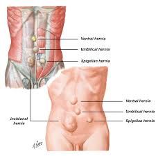 a protrusion (such as of the intestine through the inguinal wall or canal)