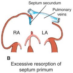 caused by: excessive resorption of septum primum or inadequate development of septum secundum

effects: significant Left-to-right shunting of blood may occur due to higher pressure on left side