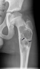 “Soap bubble” in femur or tibia on x-ray