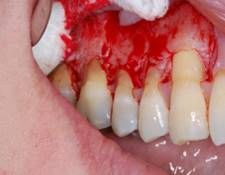 Bleeding & spongy gums