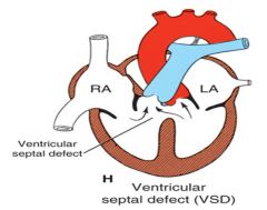 the membranous portion of the interventricular septum

***small VSDs may close spontaneously
