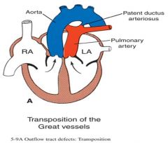 transposition of the great arteries =
-aorta rising from R ventricle & pulmonary trunk from L ventricle -->CYANOSIS

unless accompanied by shunt, to allow oxygenated blood into aorta