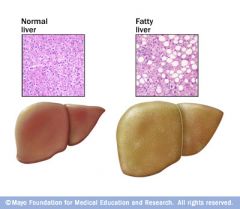 Fatty liver disease (alcoholic or metabolic syndrome)