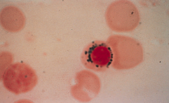 Hvilken type celle er dette, og hvilken sykdom er den forbundet med?