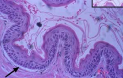 What disease has this histology?