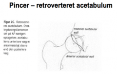 Femoroacetabulær impingement: PINCER
Retroverteret acetabulum